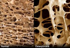 Osteoporosis, menopausia, calcio, vitaminas y carótenos