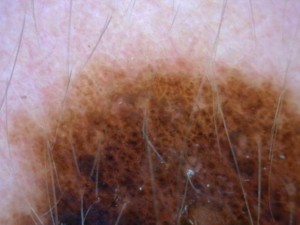 Lunares en la piel: ¿Cómo saber si son benignos o no?