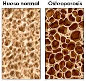 osteopor2