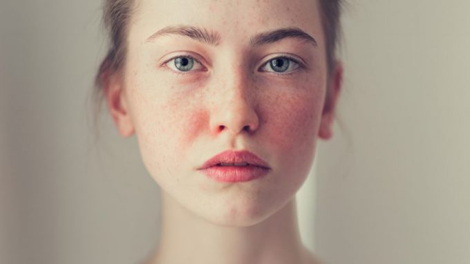 La rosácea, una enfermedad más común de lo que crees